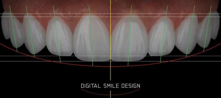 Digital Smile Design