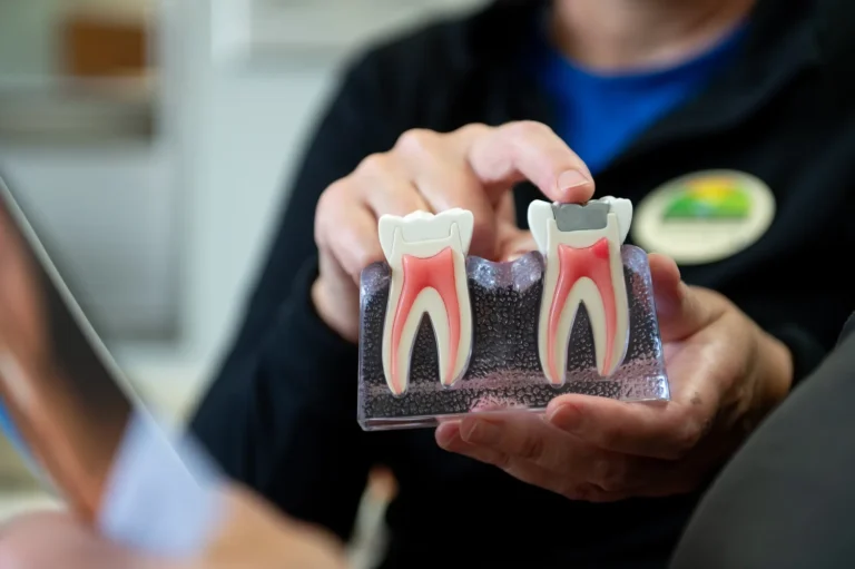 Composite Fillings