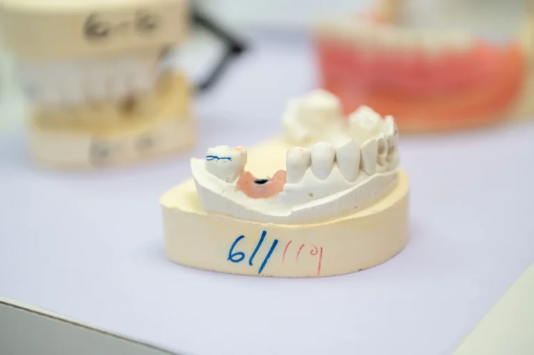 Dental Sealants